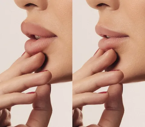 Filler Dissolving at The Standard Aesthetics