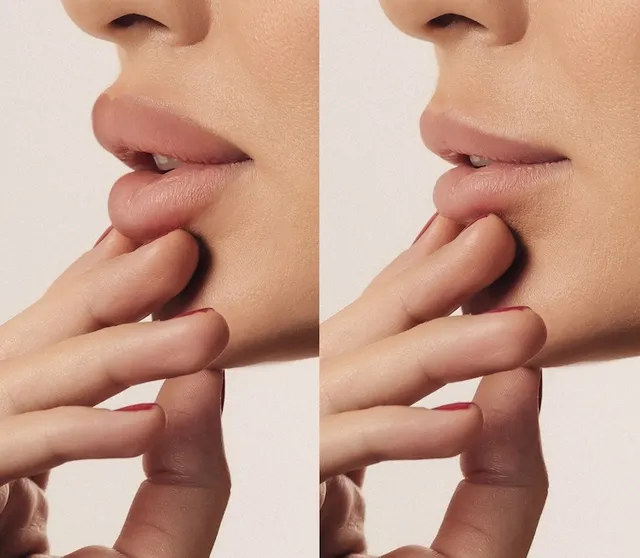 Filler Dissolving treatment at The Standard Aesthetics in Midlothian, TX