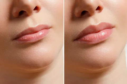 Lip Filler